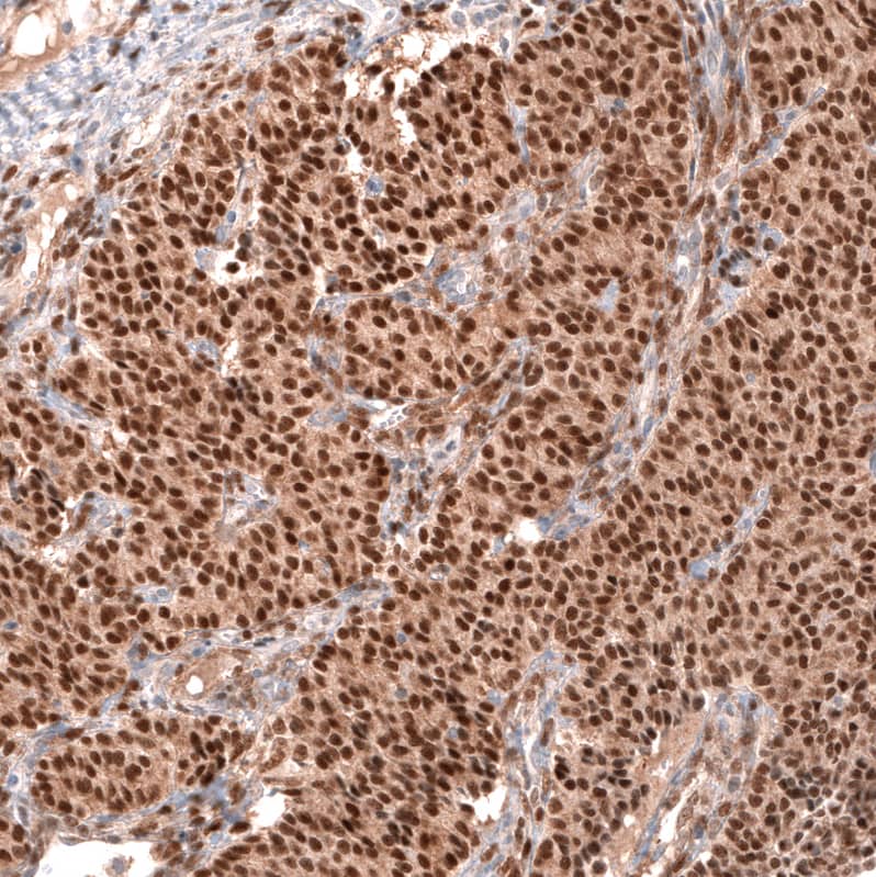 Staining of human ovarian cancer (sex cord tumor) shows strong nuclear positivity in tumor cells.