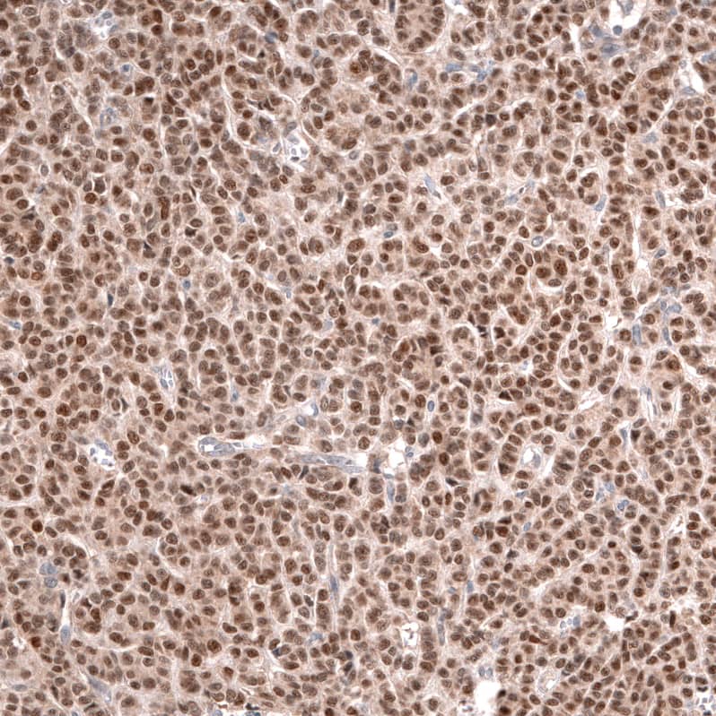 Staining of human ovarian cancer (granulosa cell tumor) shows moderate nuclear positivity in tumor cells.