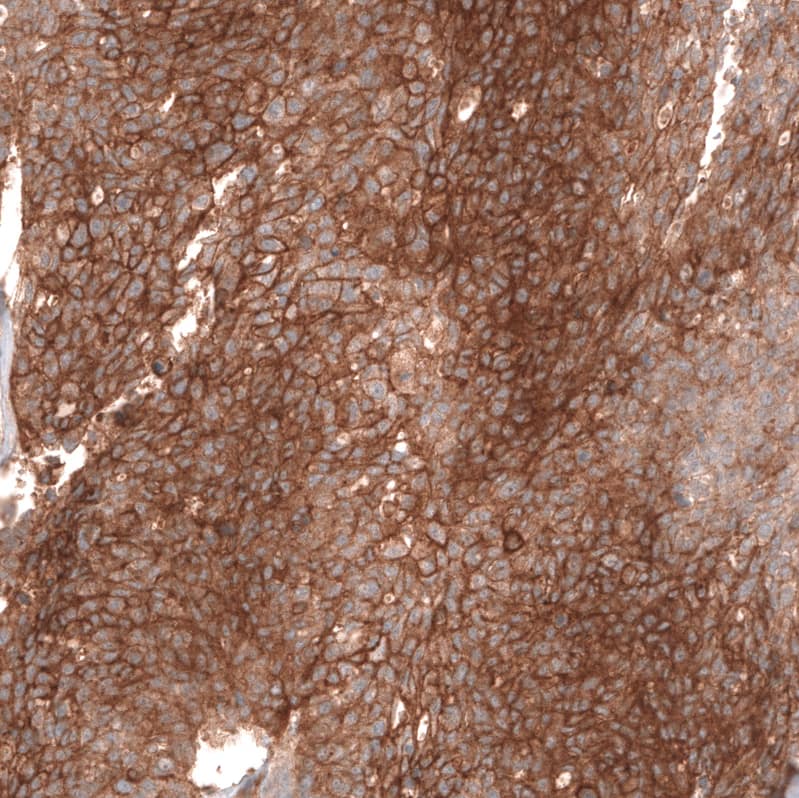 Staining of human ovarian cancer (high grade serous carcinoma) shows strong membranous positivity in tumor cells.