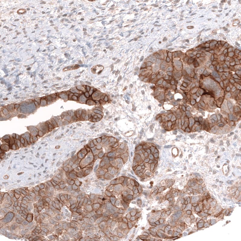 Staining of human ovarian cancer (papillary carcinoma) shows strong membranous positivity in tumor cells.