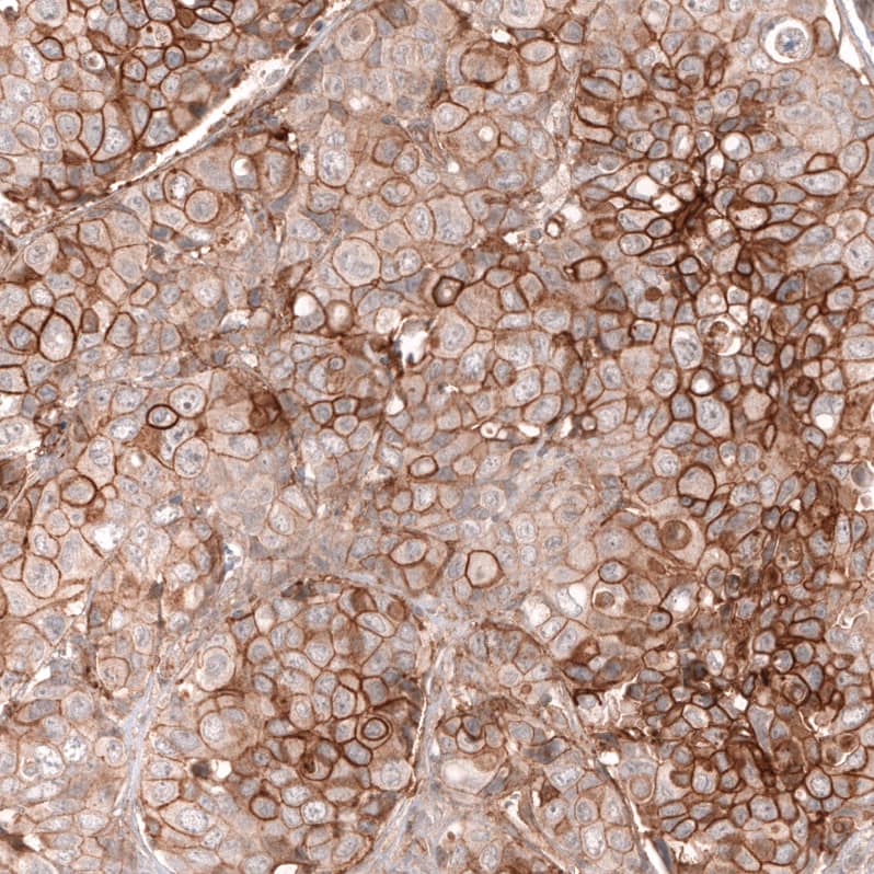 Staining of human breast cancer shows strong membranous positivity in tumor cells.