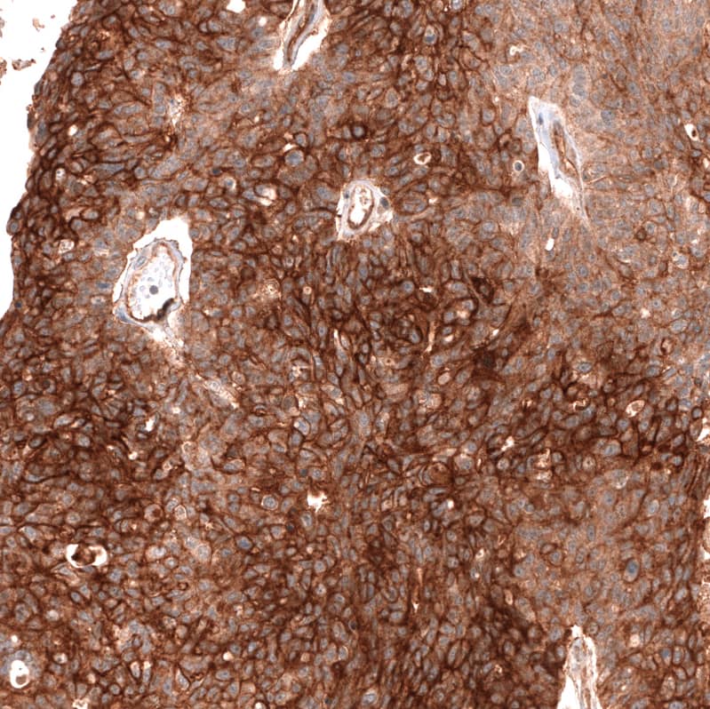 Staining of human ovarian cancer (high grade serous ovarian carcinoma) shows strong membranous positivity in tumor cells.