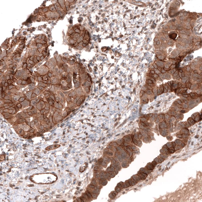 Staining of human ovarian cancer (papillary carcinoma) shows strong membranous positivity in tumor cells.