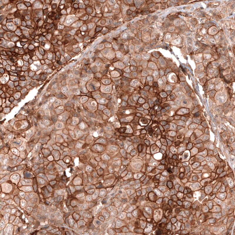 Staining of human breast cancer shows strong membranous positivity in tumor cells.