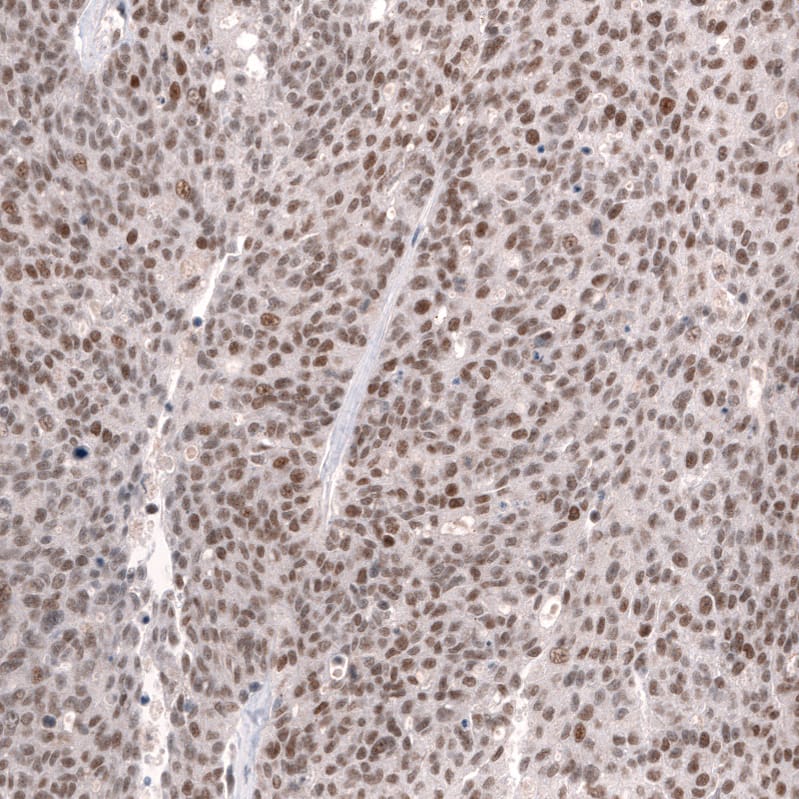 Staining of human ovarian cancer (high grade serous carcinoma) shows moderate to strong nuclear positivity in tumor cells.