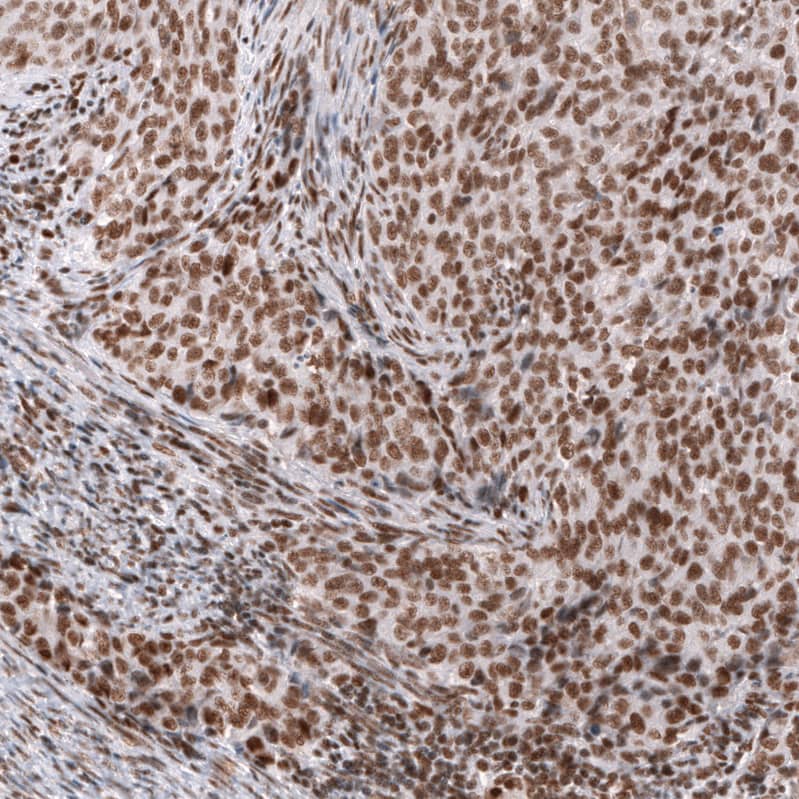 Staining of human endometrial cancer shows strong nuclear positivity in tumor cells.