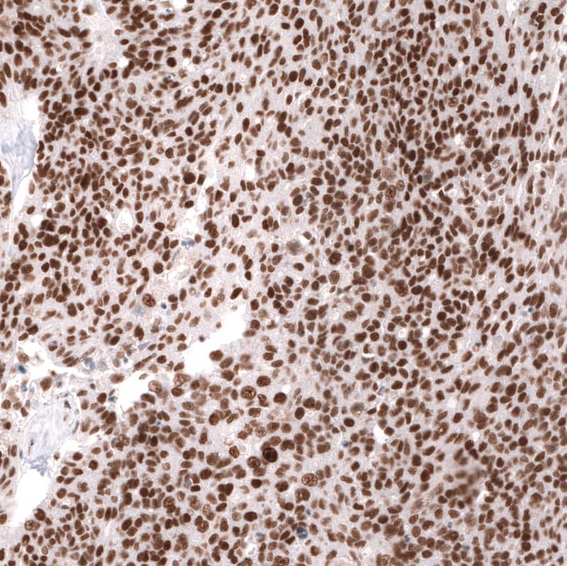 Staining of human ovarian cancer (high grade serous carcinoma) shows strong nuclear positivity in tumor cells.