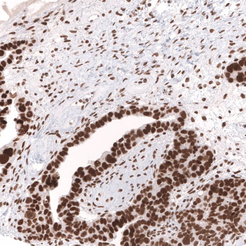 Staining of human ovarian cancer (papillary carcinoma) shows strong nuclear positivity in tumor cells.