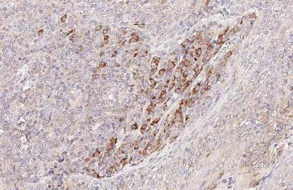 CCR4 antibody [HL2481] detects CCR4 protein by immunohistochemical analysis.Sample: Paraffin-embedded human tonsil.CCR4 stained by CCR4 antibody [HL2481] (NBP3-25402) diluted at 1:500.Antigen Retrieval: Citrate buffer, pH 6.0, 15 min 