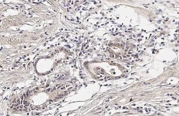 Immunohistochemistry-Paraffin: Cyr61/CCN1 Antibody (HL2144) - Azide and BSA Free [NBP3-25430] - CYR61 antibody [HL2144] detects CYR61 protein at cytoplasm by immunohistochemical analysis. Sample: Paraffin-embedded human colon cancer. CYR61 stained by CYR61 antibody [HL2144] (NBP3-25430) diluted at 1:100. Antigen Retrieval: Citrate buffer, pH 6.0, 15 min