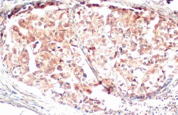 Immunohistochemistry-Paraffin: GSDMDC1 Antibody (HL1430) - Azide and BSA Free [NBP3-25478] - Gasdermin D antibody [HL1430] detects Gasdermin D protein at cell membrane and secreted by immunohistochemical analysis. Sample: Paraffin-embedded human breast carcinoma. Gasdermin D stained by Gasdermin D antibody [HL1430] (NBP3-25478) diluted at 1:100. Antigen Retrieval: Citrate buffer, pH 6.0, 15 min