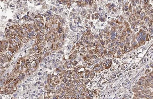 Immunohistochemistry-Paraffin: Hck Antibody (HL1673) - Azide and BSA Free [NBP3-25496] - HCK antibody [HL1673] detects HCK protein at cell membrane and cytoplasm by immunohistochemical analysis. Sample: Paraffin-embedded human hepatocellular carcinoma. HCK stained by HCK antibody [HL1673] (NBP3-25496) diluted at 1:100. Antigen Retrieval: Citrate buffer, pH 6.0, 15 min