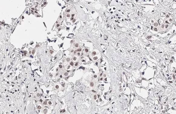 Immunohistochemistry-Paraffin: KDM6A Antibody (HL1731) - Azide and BSA Free [NBP3-25542] - KDM6A antibody [HL1731] detects KDM6A protein at nucleus by immunohistochemical analysis. Sample: Paraffin-embedded human breast carcinoma. KDM6A stained by KDM6A antibody [HL1731] (NBP3-25542) diluted at 1:100. Antigen Retrieval: Citrate buffer, pH 6.0, 15 min