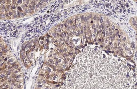 Immunohistochemistry-Paraffin: SLC7A5/LAT1 Antibody (HL2353) - Azide and BSA Free [NBP3-25549] - LAT1 / SLC7A5 antibody [HL2353] detects LAT1 / SLC7A5 protein at cell membrane by immunohistochemical analysis. Sample: Paraffin-embedded human lung cancer. LAT1 / SLC7A5 stained by LAT1 / SLC7A5 antibody [HL2353] (NBP3-25549) diluted at 1:100. Antigen Retrieval: Citrate buffer, pH 6.0, 15 min