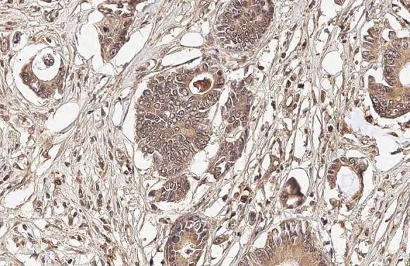 OASL antibody [HL2399] detects OASL protein at cytoplasm by immunohistochemical analysis.Sample: Paraffin-embedded human colon cancer.OASL stained by OASL antibody [HL2399] (NBP3-25583) diluted at 1:100.Antigen Retrieval: Citrate buffer, pH 6.0, 15 min 