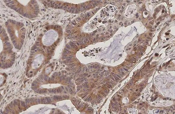 RanBP1 antibody [HL2358] detects RanBP1 protein at cytoplasm by immunohistochemical analysis.Sample: Paraffin-embedded human colon cancer.RanBP1 stained by RanBP1 antibody [HL2358] (NBP3-25621) diluted at 1:200.Antigen Retrieval: Citrate buffer, pH 6.0, 15 min 