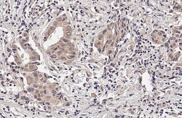 Immunohistochemistry-Paraffin: RNase H1 Antibody (HL2343) - Azide and BSA Free [NBP3-25638] - RNase H1 antibody [HL2343] detects RNase H1 protein at cytoplasm by immunohistochemical analysis. Sample: Paraffin-embedded human breast carcinoma. RNase H1 stained by RNase H1 antibody [HL2343] (NBP3-25638) diluted at 1:100. Antigen Retrieval: Citrate buffer, pH 6.0, 15 min