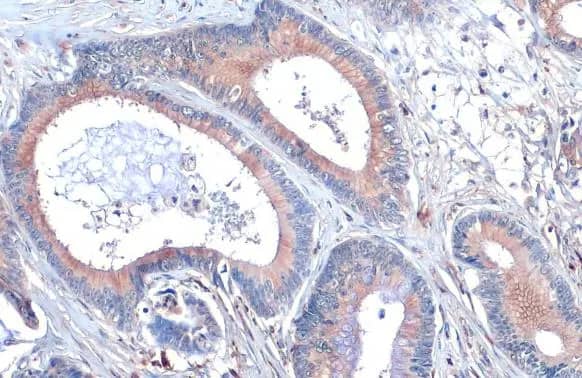 Immunohistochemistry-Paraffin: Scribble Antibody (HL1639) - Azide and BSA Free [NBP3-25673] - SCRIB antibody [HL1639] detects SCRIB protein at cell membrane and cytoplasm by immunohistochemical analysis. Sample: Paraffin-embedded human colon cancer. SCRIB stained by SCRIB antibody [HL1639] (NBP3-25673) diluted at 1:100. Antigen Retrieval: Citrate buffer, pH 6.0, 15 min