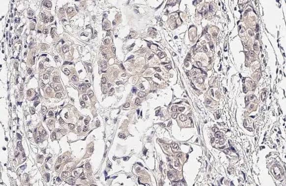 Immunohistochemistry-Paraffin: MKK4/MEK4 Antibody (HL1839) - Azide and BSA Free [NBP3-25674] - SEK1 / MKK4 antibody [HL1839] detects SEK1 / MKK4 protein at cytoplasm and nucleus by immunohistochemical analysis. Sample: Paraffin-embedded human breast carcinoma. SEK1 / MKK4 stained by SEK1 / MKK4 antibody [HL1839] (NBP3-25674) diluted at 1:50. Antigen Retrieval: Citrate buffer, pH 6.0, 15 min