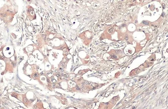 Immunohistochemistry-Paraffin: Thrombospondin-2 Antibody (HL1140) - Azide and BSA Free [NBP3-25719] - Thrombospondin 2 antibody [HL1140] detects Thrombospondin 2 protein at cytoplasm by immunohistochemical analysis. Sample: Paraffin-embedded human pancreatic cancer. Thrombospondin 2 stained by Thrombospondin 2 antibody [HL1140] (NBP3-25719) diluted at 1:100. Antigen Retrieval: Citrate buffer, pH 6.0, 15 min