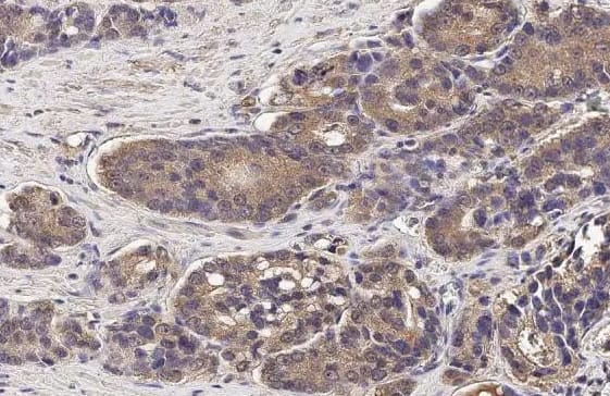 Immunohistochemistry-Paraffin Wnt-3a Antibody (HL1911) - Azide and BSA Free [NBP3-25753] - Human prostate cancer.Wnt3a stained by Wnt3a antibody [HL1911] diluted at 1:100.Antigen Retrieval: Citrate buffer, pH 6.0, 15 min.