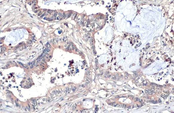 Immunohistochemistry-Paraffin: Wnt-8a Antibody (HL1648) - Azide and BSA Free [NBP3-25755] - Wnt8a antibody [HL1648] detects Wnt8a protein at cytoplasm by immunohistochemical analysis. Sample: Paraffin-embedded human colon cancer. Wnt8a stained by Wnt8a antibody [HL1648] (NBP3-25755) diluted at 1:100. Antigen Retrieval: Citrate buffer, pH 6.0, 15 min