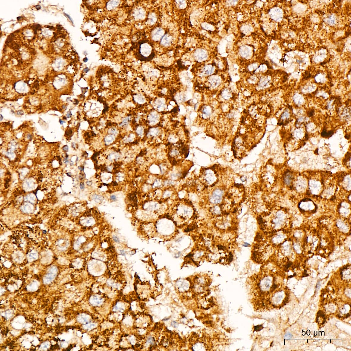 Immunohistochemistry: Glutathione Peroxidase 1/GPX1 Antibody (ARC53251) [NBP3-25943] - Immunohistochemistry analysis of paraffin-embedded Human liver cancer tissue using Glutathione Peroxidase 1/GPX1 Rabbit mAb at a dilution of 1:200 (40x lens). High pressure antigen retrieval performed with 0.01M Citrate Bufferr (pH 6.0) prior to IHC staining.