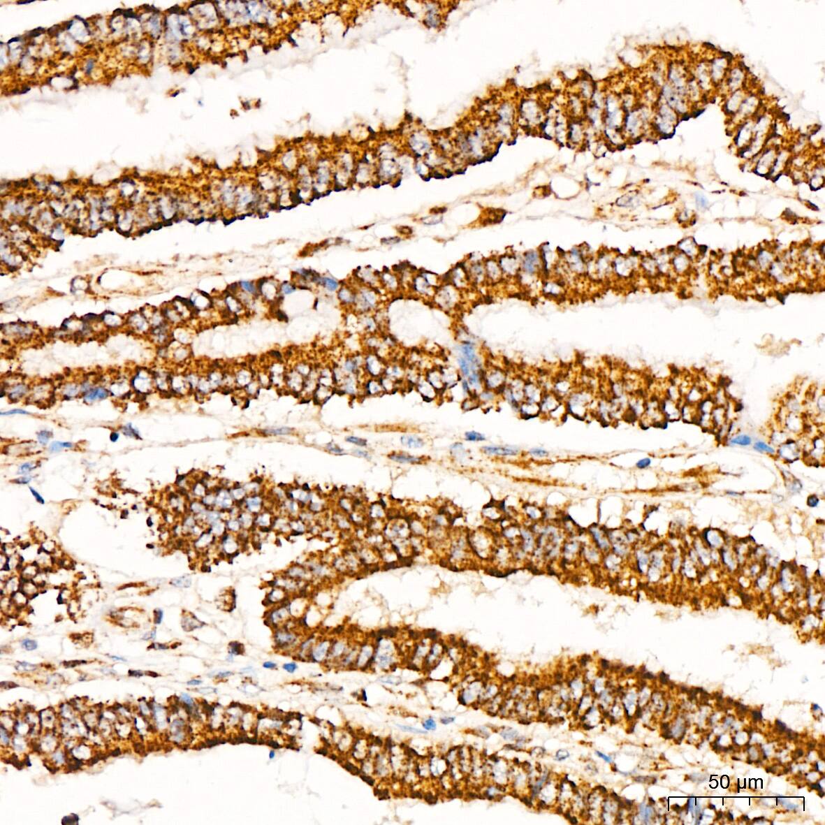 Immunohistochemistry: Glutathione Peroxidase 1/GPX1 Antibody (ARC53251) [NBP3-25943] - Immunohistochemistry analysis of paraffin-embedded Human colon carcinoma tissue using Glutathione Peroxidase 1/GPX1 Rabbit mAb at a dilution of 1:200 (40x lens). High pressure antigen retrieval performed with 0.01M Citrate Bufferr (pH 6.0) prior to IHC staining.