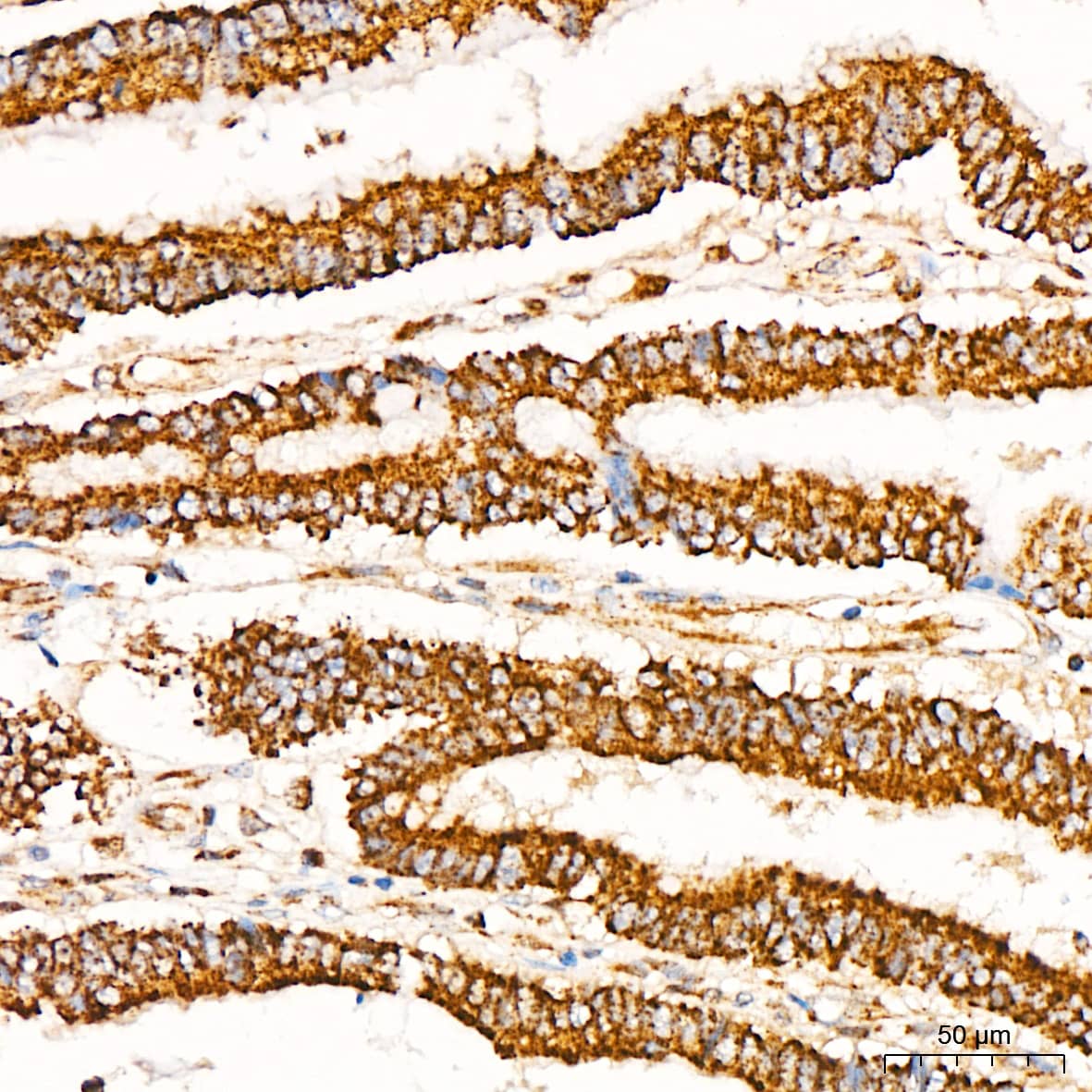 Immunohistochemistry: Glutathione Peroxidase 1/GPX1 Antibody  [Glutathione Peroxidase 1/GPX1] - Immunohistochemistry analysis of paraffin-embedded Human colon carcinoma tissue using Glutathione Peroxidase 1/GPX1 Rabbit mAb  at a dilution of 1:200 (40x lens). High pressure antigen retrieval performed with 0.01M Citrate Bufferr (pH 6.0) prior to IHC staining.