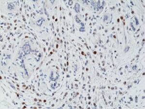 Immunohistochemistry-Paraffin: Histone H3 [p Thr3] Antibody (RM159) - Azide and BSA Free [NBP3-26019] - Immunohistochemical staining of formalin fixed and paraffin embedded human breast cancer tissue section using Clone RM159 at a 1 ug/mL.