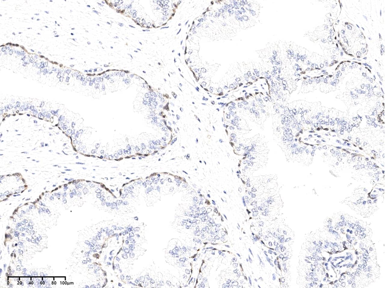 Immunohistochemistry-Paraffin: Kallikrein 15 Antibody (02) - Azide and BSA Free [NBP3-26079] - Immunochemical staining of human Kallikrein 15 in human prostate with NBP3-26079 at 1:200 dilution, formalin-fixed paraffin embedded sections.