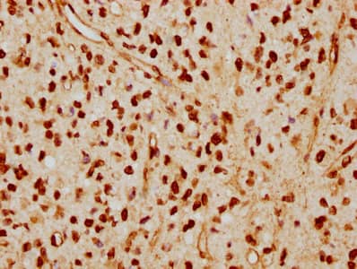 Immunohistochemistry: Lamin A + C Antibody (4H7) [NBP3-26167] - Image of Lamin A + C Antibody (4H7) diluted at 1:115 and staining in paraffin-embedded human glioma cancer performed. After dewaxing and hydration, antigen retrieval was mediated by high pressure in a citrate buffer (pH 6.0). Section was blocked with 10% normal goat serum 30min at RT. Then primary antibody (1% BSA) was incubated at 4C overnight. The primary is detected by a biotinylated secondary antibody and visualized using an HRP conjugated SP system.