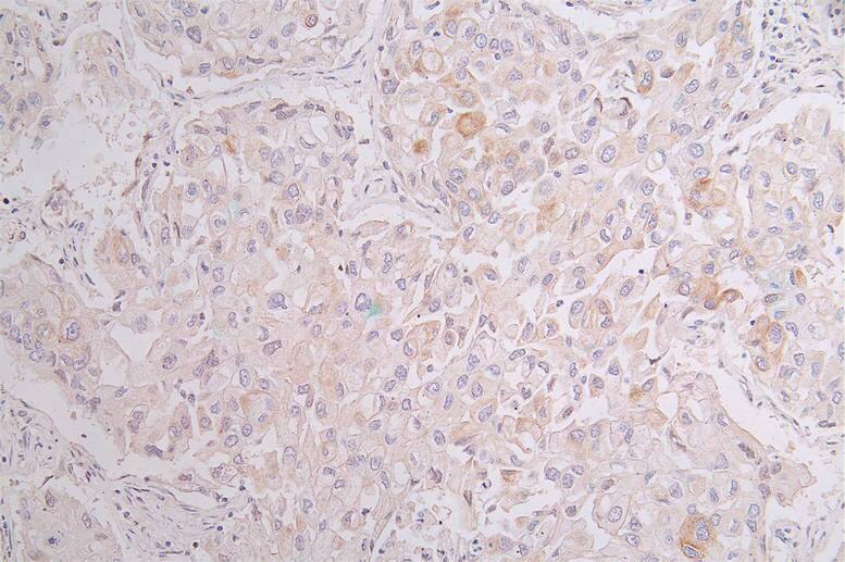 Immunohistochemistry: Cytokeratin 10 Antibody (18B6) [NBP3-26178] - Image of Cytokeratin 10 Antibody (18B6) diluted at 1:50 and staining in paraffin-embedded human pancreati tissue performed. After dewaxing and hydration, antigen retrieval was mediated by high pressure in a citrate buffer (pH 6.0). Section was blocked with 10% normal goat serum 30min at RT. Then primary antibody (1% BSA) was incubated at 4°C overnight. The primary is detected by a Goat anti-rabbit polymer IgG labeled by HRP and visualized using 0.34% DAB.