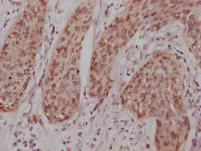 Immunohistochemistry: c-jun Antibody (10D4) [NBP3-26186] - Image of c-jun Antibody (10D4) diluted at 1:100 and staining in paraffin-embedded human cervical cancer performed. After dewaxing and hydration, antigen retrieval was mediated by high pressure in a citrate buffer (pH 6.0). Section was blocked with 10% normal goat serum 30min at RT. Then primary antibody (1% BSA) was incubated at 4C overnight. The primary is detected by a Goat anti-rabbit IgG polymer labeled by HRP and visualized using 0.05% DAB.