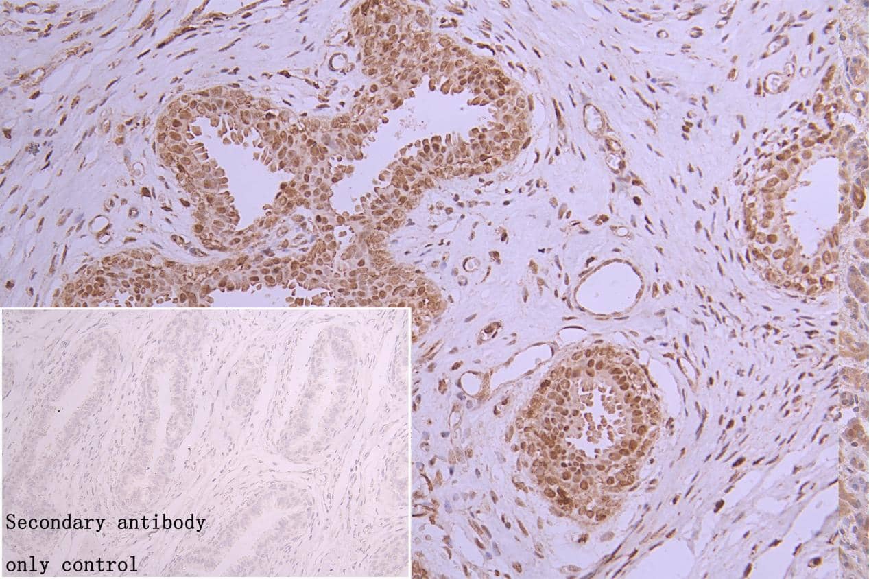 Immunohistochemistry: hnRNP C1 + C2 Antibody (9G1) [NBP3-26221] - NBP3-26221 diluted at 1:300 and staining in paraffin-embedded  human breast cancer performed on a Leica BondTM system. After dewaxing and hydration, antigen retrieval was mediated by high pressure in a citrate buffer (pH 6.0). Section was blocked with 10% normal goat serum 30min at RT. Then primary antibody (1% BSA) was incubated at 4°C overnight. The primary is detected by a Goat anti-rabbit polymer IgG labeled by HRP and visualized using 0.05% DAB.Secondary antibody only control: uses 1% BSA instead of primary antibody