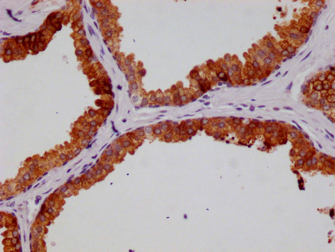 Immunohistochemistry: HGD Antibody (20D12) [NBP3-26234] - Image of HGD Antibody (20D12) diluted at 1:100 and staining in paraffin-embedded human liver cancer performed. After dewaxing and hydration, antigen retrieval was mediated by high pressure in a citrate buffer (pH 6.0). Section was blocked with 10% normal goat serum 30min at RT. Then primary antibody (1% BSA) was incubated at 4C overnight. The primary is detected by a Goat anti-rabbit polymer IgG labeled by HRP and visualized using 0.05% DAB.