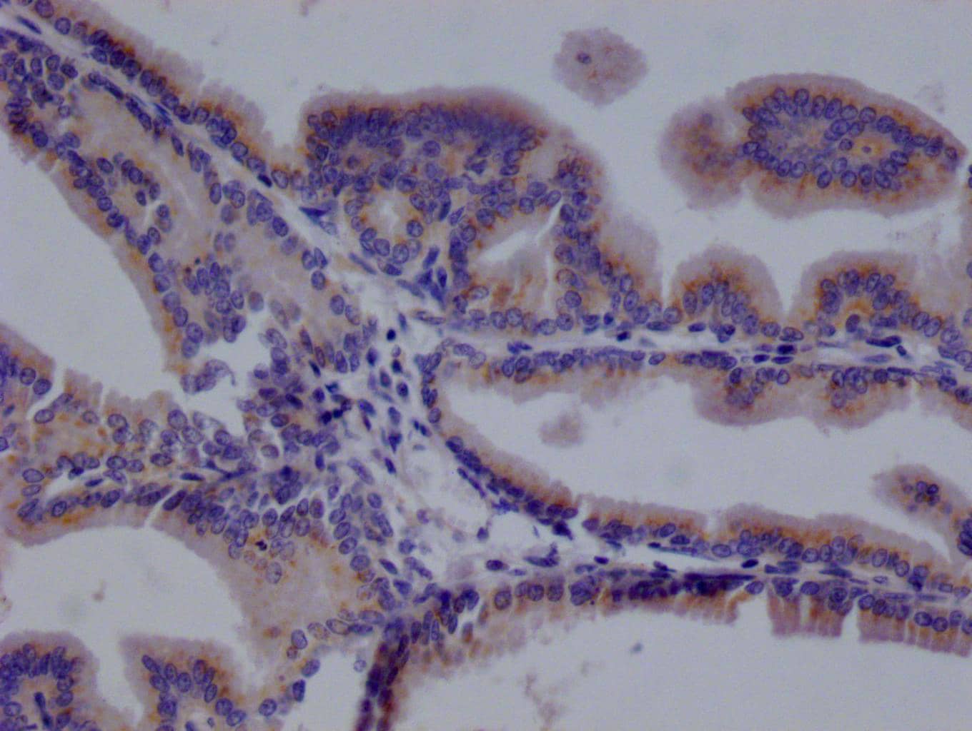 Immunohistochemistry: TMEM192 Antibody (21G8) [NBP3-26281] - Image of TMEM192 Antibody (21G8) diluted at 1:100 and staining in paraffin-embedded human prostate tissue performed. After dewaxing and hydration, antigen retrieval was mediated by high pressure in a citrate buffer (pH 6.0). Section was blocked with 10% normal goat serum 30min at RT. Then primary antibody (1% BSA) was incubated at 4°C overnight. The primary is detected by a Goat anti-rabbit polymer IgG labeled by HRP and visualized using 0.05% DAB.