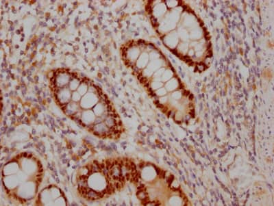 Immunohistochemistry: SOX9 Antibody (5H12) [NBP3-26304] - Image of SOX9 Antibody (5H12) diluted at 1:100 and staining in paraffin-embedded human colon cancer performed. After dewaxing and hydration, antigen retrieval was mediated by high pressure in a citrate buffer (pH 6.0). Section was blocked with 10% normal goat serum 30min at RT. Then primary antibody (1% BSA) was incubated at 4C overnight. The primary is detected by a Goat anti-rabbit IgG polymer labeled by HRP and visualized using 0.05% DAB.