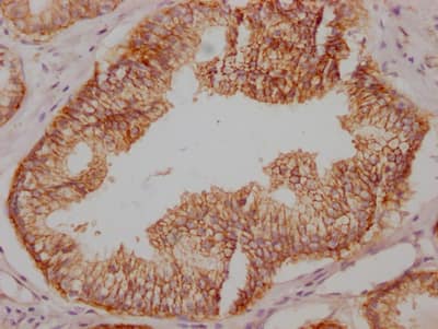 Immunohistochemistry: SNAP23 Antibody (2D8) [NBP3-26311] - Image of SNAP23 Antibody (2D8) diluted at 1:100 and staining in paraffin-embedded human prostate cancer performed. After dewaxing and hydration, antigen retrieval was mediated by high pressure in a citrate buffer (pH 6.0). Section was blocked with 10% normal goat serum 30min at RT. Then primary antibody (1% BSA) was incubated at 4C overnight. The primary is detected by a Goat anti-rabbit IgG polymer labeled by HRP and visualized using 0.05% DAB.