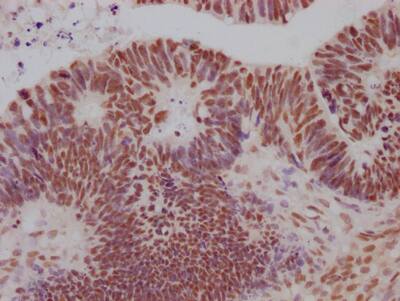 Immunohistochemistry: SIN3A Antibody (10G3) [NBP3-26325] - Image of SIN3A Antibody (10G3) diluted at 1:100 and staining in paraffin-embedded human ovarian cancer performed. After dewaxing and hydration, antigen retrieval was mediated by high pressure in a citrate buffer (pH 6.0). Section was blocked with 10% normal goat serum 30min at RT. Then primary antibody (1% BSA) was incubated at 4C overnight. The primary is detected by a Goat anti-rabbit IgG polymer labeled by HRP and visualized using 0.05% DAB.