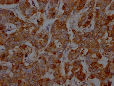 Immunohistochemistry: S100A9 Antibody (2E9) [NBP3-26338] - Image of S100A9 Antibody (2E9) diluted at 1:100 and staining in paraffin-embedded human breast cancer performed. After dewaxing and hydration, antigen retrieval was mediated by high pressure in a citrate buffer (pH 6.0). Section was blocked with 10% normal goat serum 30min at RT. Then primary antibody (1% BSA) was incubated at 4C overnight. The primary is detected by a Goat anti-rabbit IgG polymer labeled by HRP and visualized using 0.05% DAB.