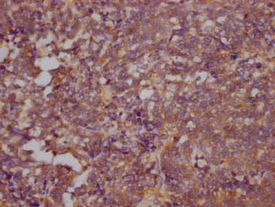 Immunohistochemistry: RhoA Antibody (3G7) [NBP3-26344] - Image of RhoA Antibody (3G7) diluted at 1:100 and staining in paraffin-embedded human lung cancer performed. After dewaxing and hydration, antigen retrieval was mediated by high pressure in a citrate buffer (pH 6.0). Section was blocked with 10% normal goat serum 30min at RT. Then primary antibody (1% BSA) was incubated at 4C overnight. The primary is detected by a Goat anti-rabbit IgG polymer labeled by HRP and visualized using 0.05% DAB.