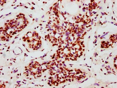 Immunohistochemistry: Nrf2 [p Ser40] Antibody (2E6) [NBP3-26402] - Image of  Nrf2 [p Ser40] Antibody diluted at 1:100 and staining in paraffin-embedded human breast cancer performed. After dewaxing and hydration, antigen retrieval was mediated by high pressure in a citrate buffer (pH 6.0). Section was blocked with 10% normal goat serum 30min at RT. Then primary antibody (1% BSA) was incubated at 4C overnight. The primary is detected by a biotinylated secondary antibody and visualized using an HRP conjugated SP system.