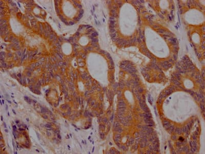 Immunohistochemistry: PLGF Antibody (1B6) [NBP3-26432] - Image of PLGF Antibody (1B6) diluted at 1:100 and staining in paraffin-embedded human colon cancer performed. After dewaxing and hydration, antigen retrieval was mediated by high pressure in a citrate buffer (pH 6.0). Section was blocked with 10% normal goat serum 30min at RT. Then primary antibody (1% BSA) was incubated at 4C overnight. The primary is detected by a Goat anti-rabbit IgG polymer labeled by HRP and visualized using 0.05% DAB.