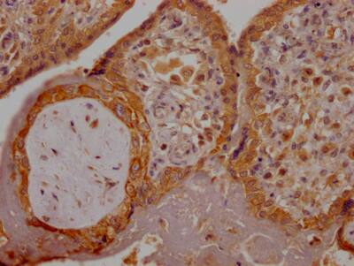 Immunohistochemistry: PLGF Antibody (1B6) [NBP3-26432] - Image of PLGF Antibody (1B6) diluted at 1:100 and staining in paraffin-embedded human colon cancer performed. After dewaxing and hydration, antigen retrieval was mediated by high pressure in a citrate buffer (pH 6.0). Section was blocked with 10% normal goat serum 30min at RT. Then primary antibody (1% BSA) was incubated at 4C overnight. The primary is detected by a Goat anti-rabbit IgG polymer labeled by HRP and visualized using 0.05% DAB.