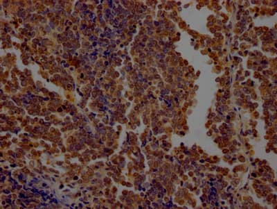 Immunohistochemistry: O-GlcNAc Transferase p110 subunit Antibody (8G7) [NBP3-26448] - Image of O-GlcNAc Transferase p110 subunit Antibody (8G7) diluted at 1:100 and staining in paraffin-embedded human lung cancer performed. After dewaxing and hydration, antigen retrieval was mediated by high pressure in a citrate buffer (pH 6.0). Section was blocked with 10% normal goat serum 30min at RT. Then primary antibody (1% BSA) was incubated at 4C overnight. The primary is detected by a Goat anti-rabbit IgG polymer labeled by HRP and visualized using 0.05% DAB.