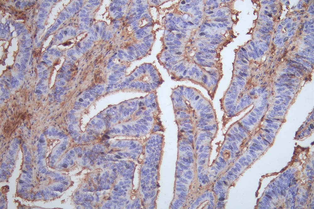 Immunohistochemistry: Occludin Antibody (8H8) [NBP3-26449] - Image of Occludin Antibody (8H8) diluted at 1:100 and staining in paraffin-embedded human colon cancer performed. After dewaxing and hydration, antigen retrieval was mediated by high pressure in a citrate buffer (pH 6.0). Section was blocked with 10% normal goat serum 30min at RT. Then primary antibody (1% BSA) was incubated at 4°C overnight. The primary is detected by a Goat anti-rabbit polymer IgG labeled by HRP and visualized using 0.05% DAB.