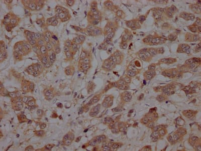 Immunohistochemistry: Caspase-3 Antibody (2B10) [NBP3-26461] - Image of Caspase-3 Antibody (2B10) diluted at 1:100 and staining in paraffin-embedded human breast cancer performed. After dewaxing and hydration, antigen retrieval was mediated by high pressure in a citrate buffer (pH 6.0). Section was blocked with 10% normal goat serum 30min at RT. Then primary antibody (1% BSA) was incubated at 4C overnight. The primary is detected by a Goat anti-rabbit IgG polymer labeled by HRP and visualized using 0.05% DAB.