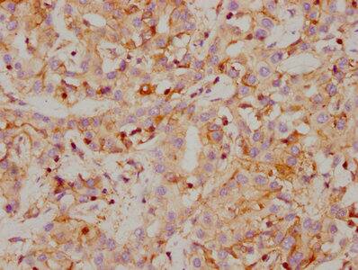 Immunohistochemistry: Carbonic Anhydrase IX/CA9 Antibody (4F12) [NBP3-26468] - Image of Carbonic Anhydrase IX/CA9 Antibody (4F12) diluted at 1:118 and staining in paraffin-embedded human gastric cancer performed. After dewaxing and hydration, antigen retrieval was mediated by high pressure in a citrate buffer (pH 6.0). Section was blocked with 10% normal goat serum 30min at RT. Then primary antibody (1% BSA) was incubated at 4C overnight. The primary is detected by a biotinylated secondary antibody and visualized using an HRP conjugated SP system.