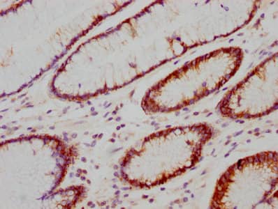 Immunohistochemistry: Carbonic Anhydrase IX/CA9 Antibody (4F12) [NBP3-26468] - Image of Carbonic Anhydrase IX/CA9 Antibody (4F12) diluted at 1:118 and staining in paraffin-embedded human gastric cancer performed. After dewaxing and hydration, antigen retrieval was mediated by high pressure in a citrate buffer (pH 6.0). Section was blocked with 10% normal goat serum 30min at RT. Then primary antibody (1% BSA) was incubated at 4C overnight. The primary is detected by a biotinylated secondary antibody and visualized using an HRP conjugated SP system.